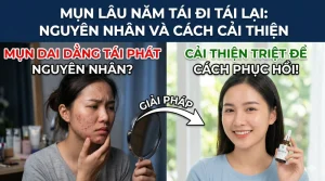 mụn lâu năm tái đi tái lại: nguyên nhân và cách cải thiện